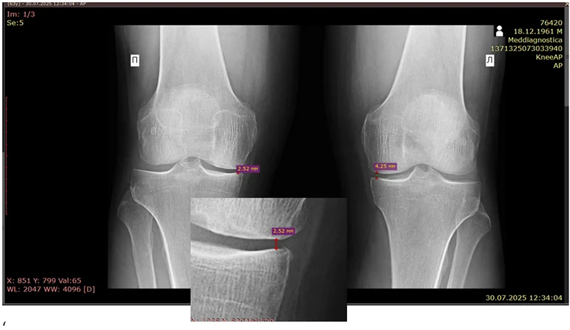 Відновлення хряща в колінному суглобі можливо