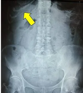 боль в грудях