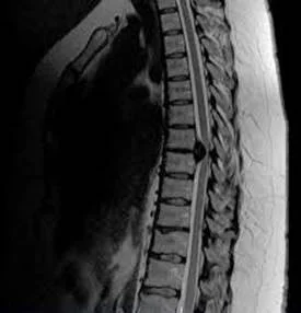 боль в груди при грыже