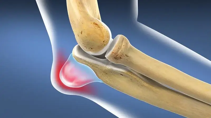 бурсит ліктя