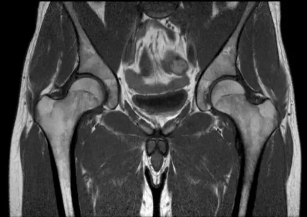 МРТ кульшового суглоба
