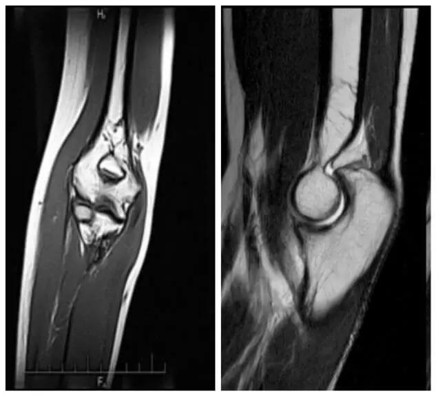 МРТ ліктьового суглоба