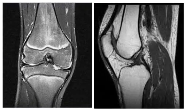 МРТ колінного суглоба
