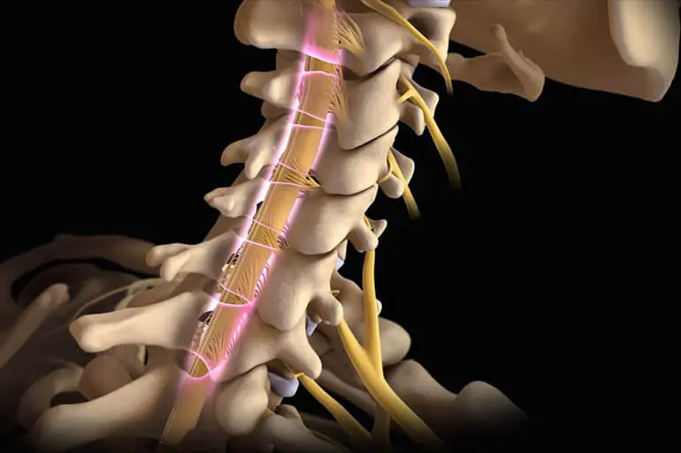 Корешковый синдром