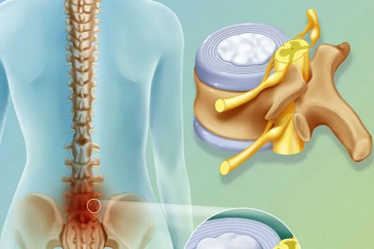 Межпозвоночная грыжа