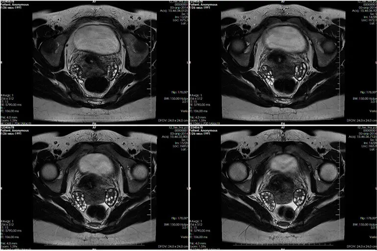 МРТ органів малого тазу Розшифровка результатів