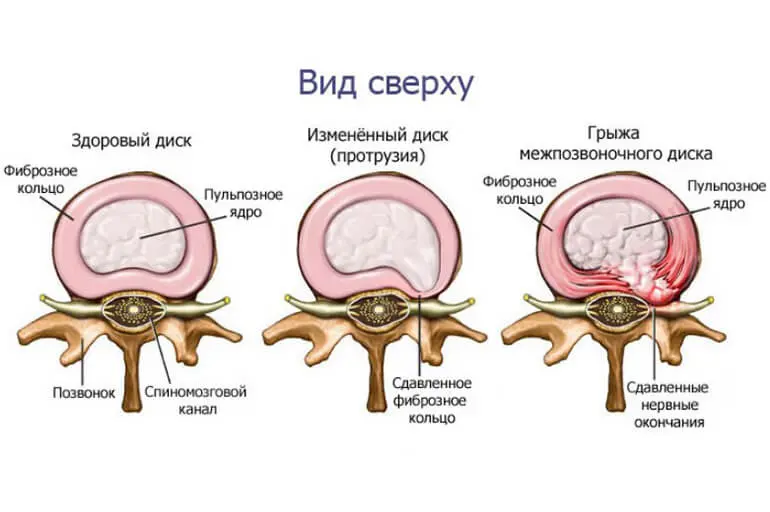 Стадии развития грыжи