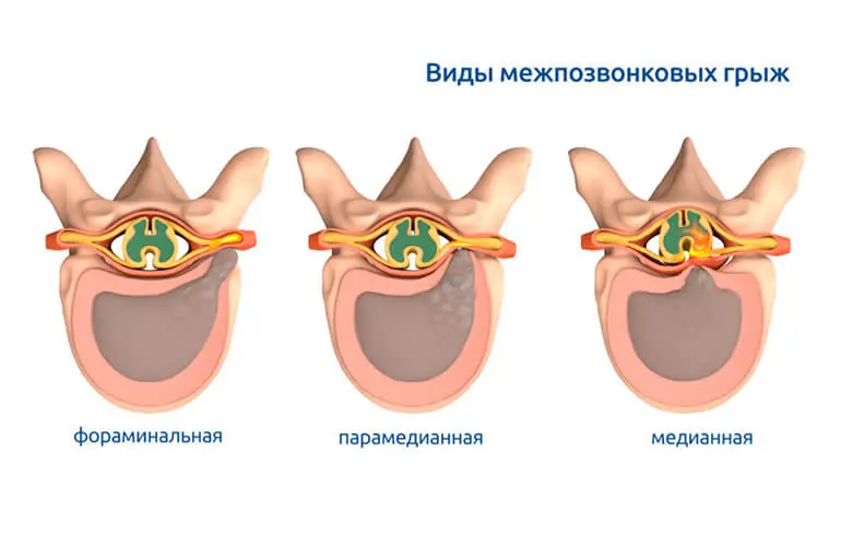 Типы межпозвонковых грыж