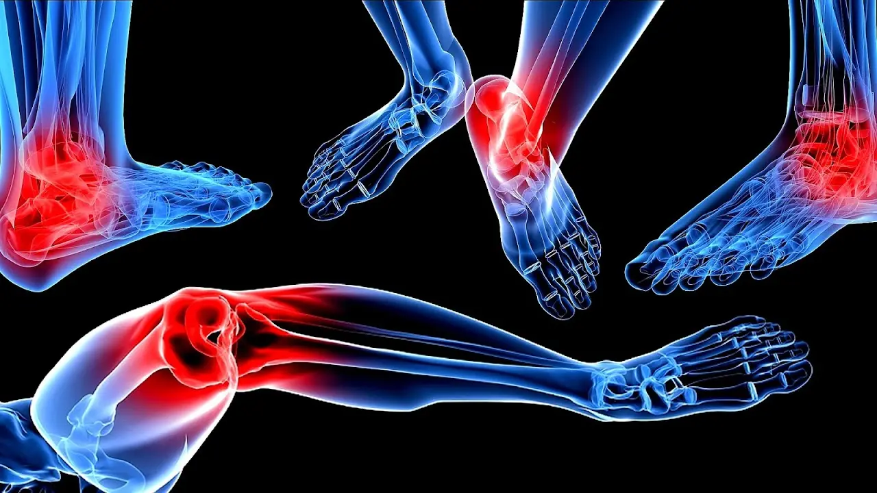 Артрит нижніх кінцівок