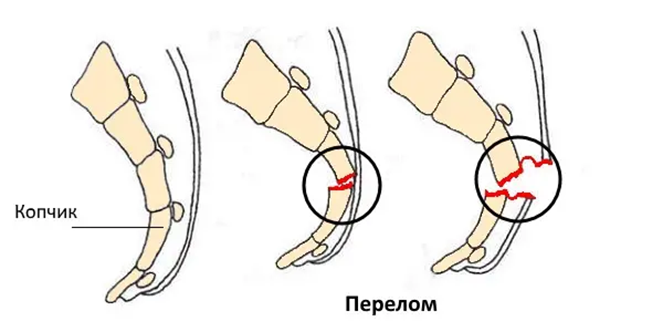 Почему болит копчик? Причины боли в копчике. Что делать при болях в копчике у мужчин и женщин?