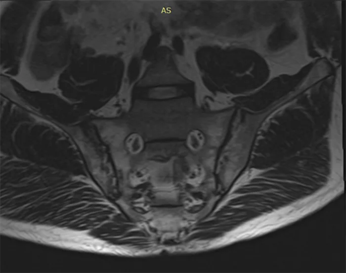 магнітно-резонансна томографія крижово-клубових суглобів