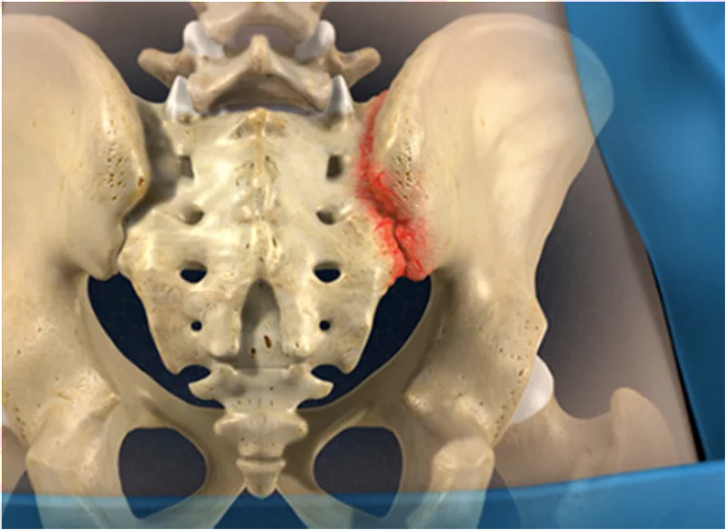мрт крижово-клубового суглоба