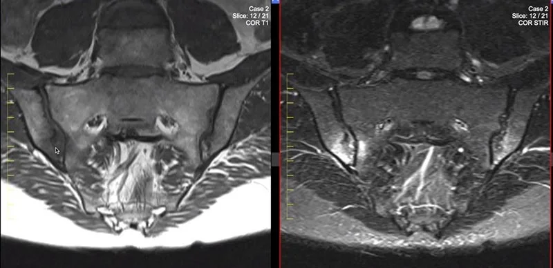 мрт крижово-клубових суглобів