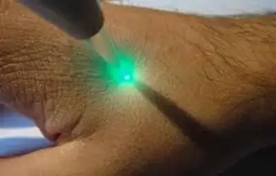 лазеропунктура київ