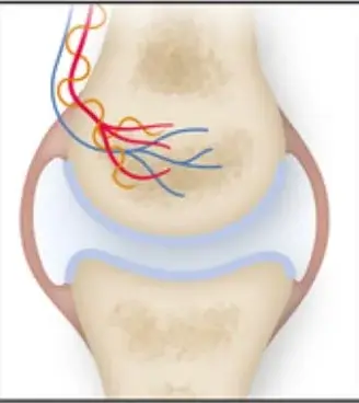 остеоартроз симптоми