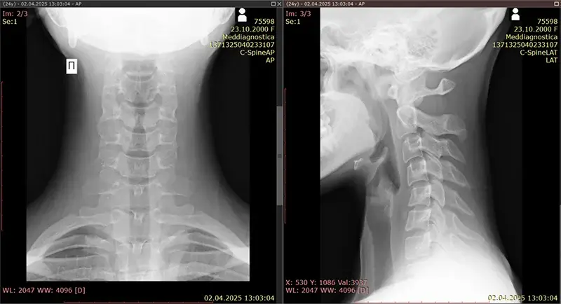 лордоз шийного відділу хребта