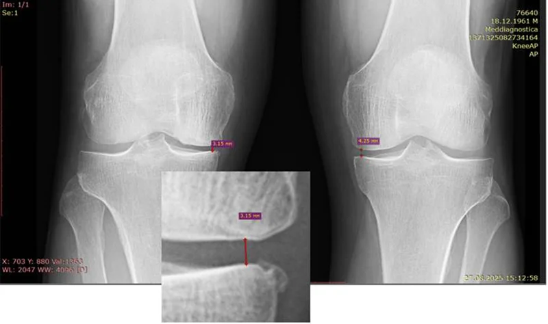 відновлення хряща коліна