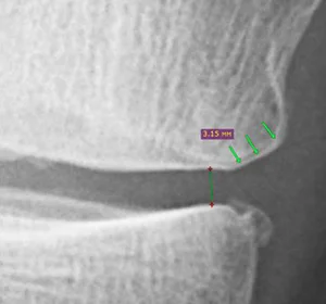 Відновлення хряща в колінному суглобі можливо